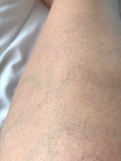 Does IPL at home work - Philips Lumea Review leg hair